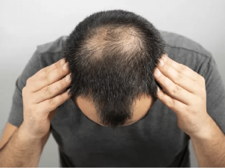 Afinal porque é que o Ruca é careca — doença ou mito urbano? – NiT