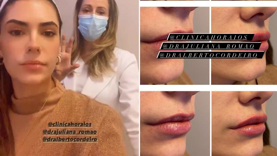 Jade Magalhães mostrou o resultado do procedimento de preenchimento labial - Reprodução/Instagram