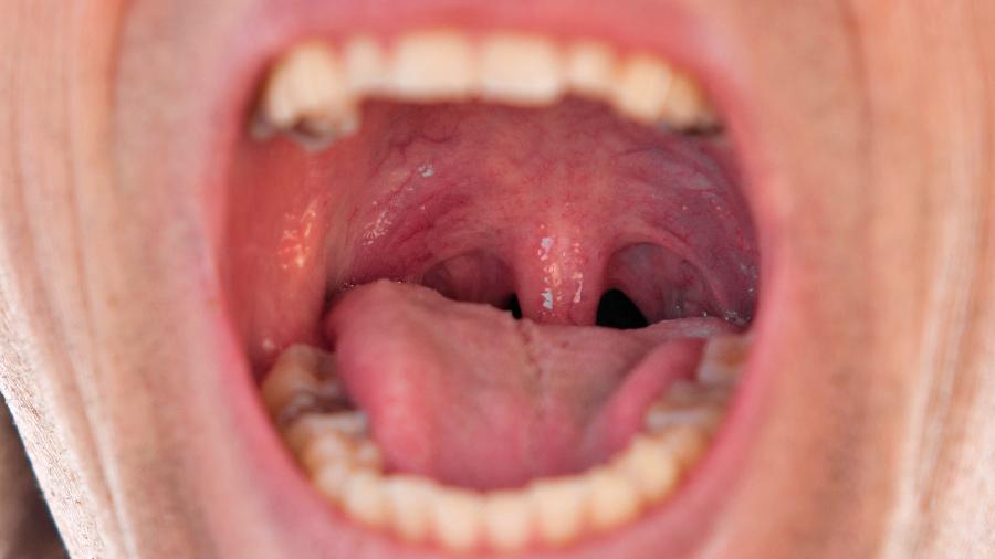 Cáseos amigdalianos são bolinhas que surgem no fundo da boca, na região da garganta - Getty Images