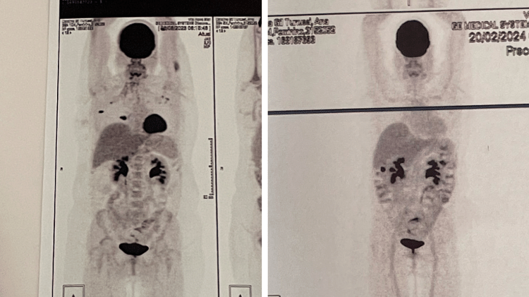 Antes e depois da terapia CAR-T: em agosto de 2023 (esq.) e fevereiro de 2024 (dir.)