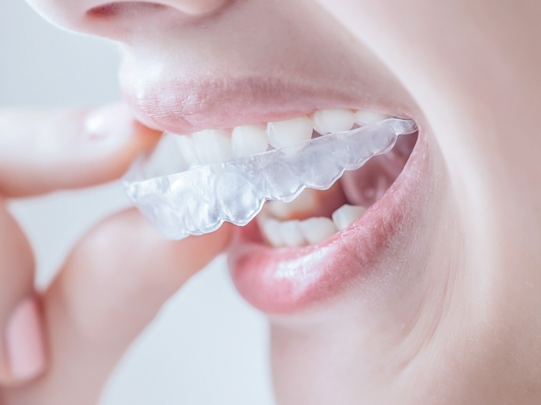 Como funciona o alinhador dental transparente? Ele é melhor que o de metal?  - 27/06/2019 - UOL VivaBem