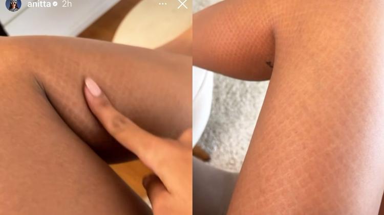 Anitta mostra como ficou sua perna após bloco de Carnaval