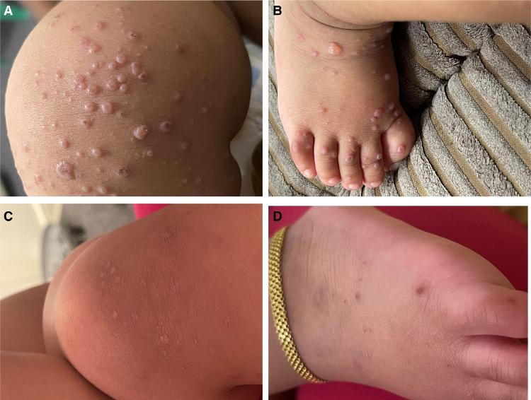 gripe do tomate, doença mão-pé-boca - The Pediatric Infectious Disease Journal - The Pediatric Infectious Disease Journal