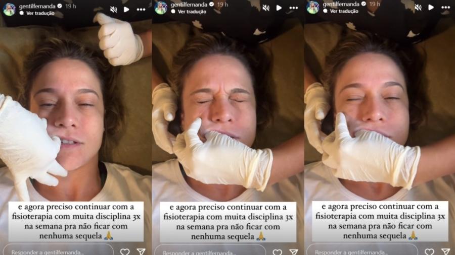 Fernanda Gentil faz tratamento para Paralisia de Bell com fisioterapia facial - Reprodução/Instagram