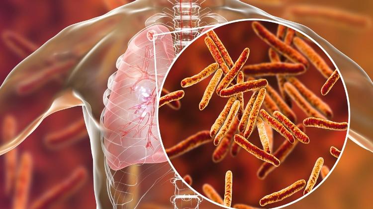 Bacilo de Koch é o causador da tuberculose