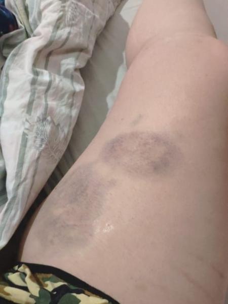 Vítima ficou com marcas roxas nas pernas - Arquivo Pessoal