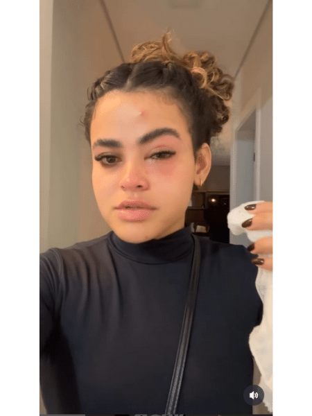 Mulher fica com olho vermelho e inchado por causa de mosca de banheiro Mulher fica com olho vermelho e inchado por causa de mosca de banheiro