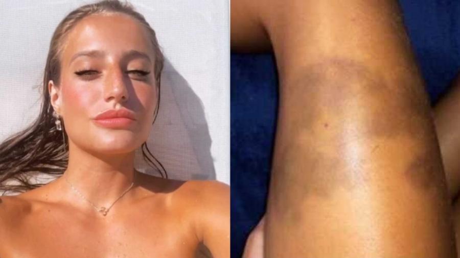 Bruna Griphao tranquiliza seguidores após aparecer com manchas roxas na perna - Reprodução/Instagram