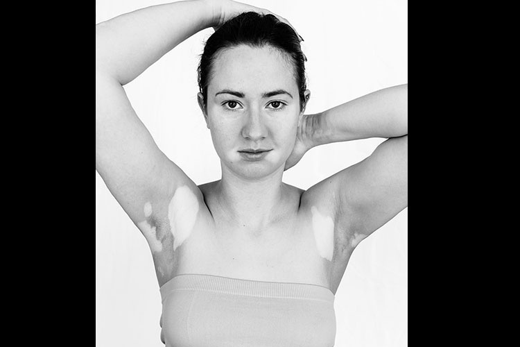 Modelos com vitiligo - Divulgação/Julia Kaczorowska
