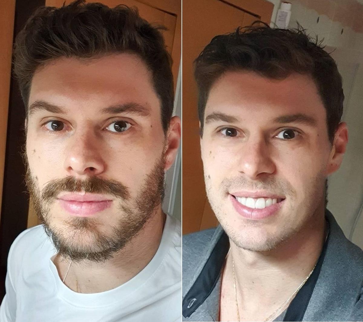 Bruninho (jogador de vôlei) "Dizem que o vírus pode ficar retido por mais tempo na barba. Então nesse momento, não custa nada tirar", escreveu o jogador de vôlei ao - Reprodução/Instagram