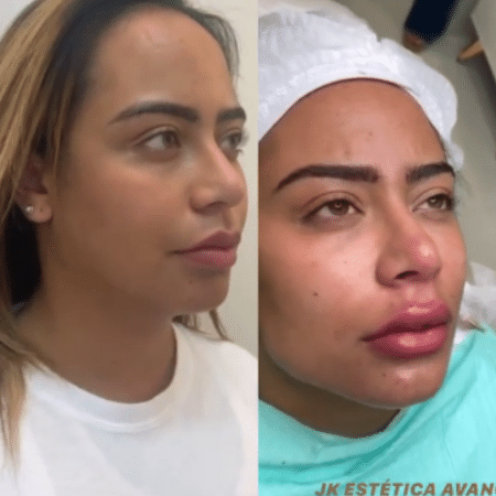 Médico exaltou a mudança no rosto da irmã de Neymar - Reprodução/Instagram/@drsamuelmontalvao