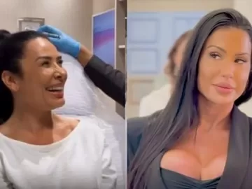 Scheila e Gracyanne reverteram harmonização facial; qual o 'antídoto'?