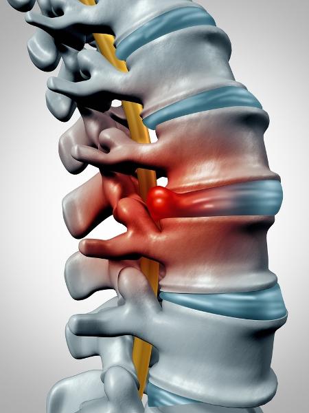A hérnia de disco ocorre quando a "borracha" (em azul) entre as vértebras vai além das bordas delas - iStock