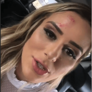 Letícia Santiago com a cabeça machucada - Instagram/Reprodução - Instagram/Reprodução