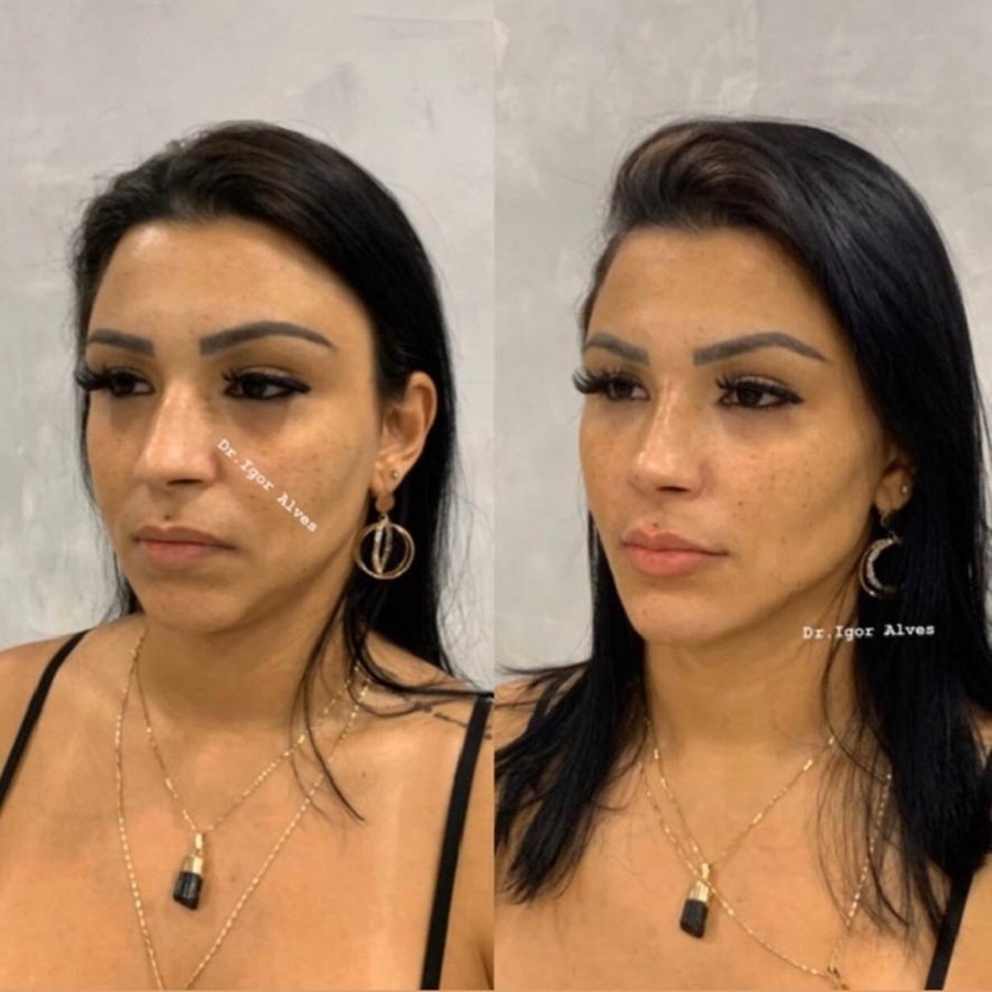 Jenny Miranda mostra antes e depois e harmonização facial feita pelo  namorado - Revista Marie Claire