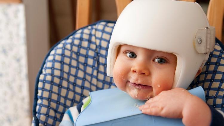 Capacete ortopédico é tratamento brando e posicional