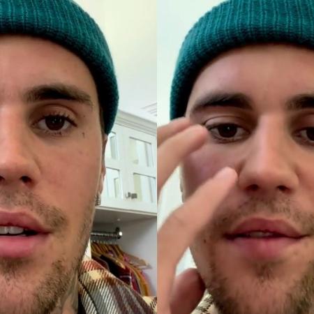 Justin Bieber compartilhou um vídeo nas redes sociais para explicar a síndrome - Reprodução/Instagram
