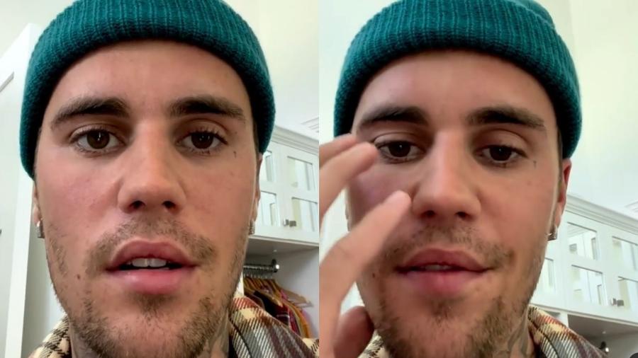 Justin Bieber compartilhou um vídeo nas redes sociais para explicar a síndrome rara que está afetando a sua saúde - Reprodução/Instagram
