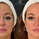 Mãe de Neymar, Nadine realizou um procedimento de rejuvenescimento facial - undefined