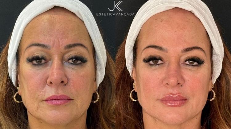 Mãe de Neymar, Nadine realizou um procedimento de rejuvenescimento facial