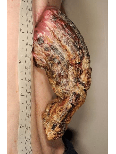 Chifre, conhecido como corno cutâneo, chegou a 14 cm de comprimento - Reprodução/BMJ Case Reports