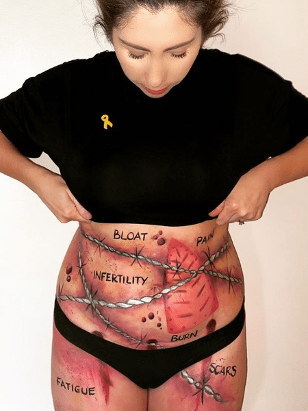 Ruth Anne mostra a realidade de quem vive com endometriose - Reprodução/Instagram