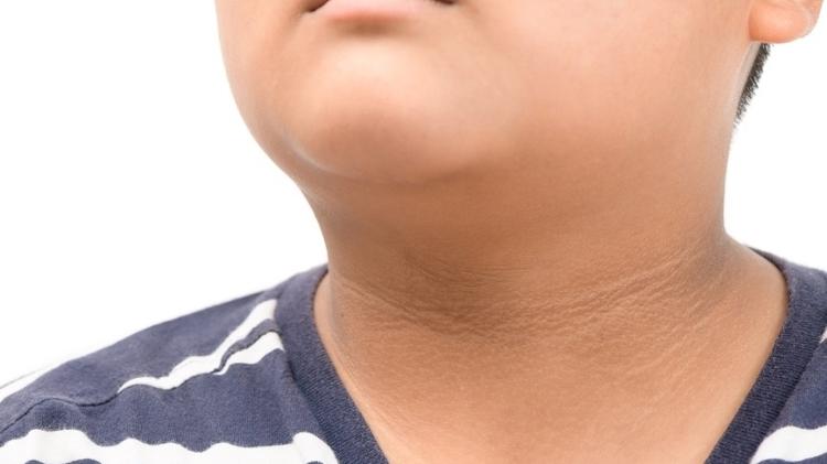 Mancha escura no pescoço - iStock - iStock