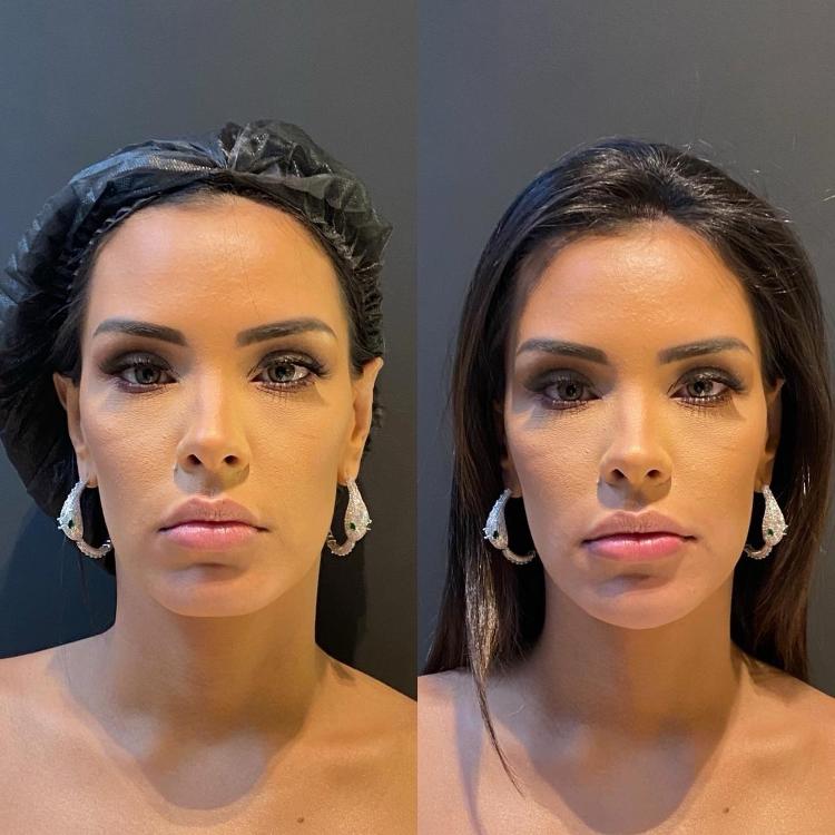 Ivy Moraes antes e depois de procedimentos estéticos - Divulgação - Divulgação