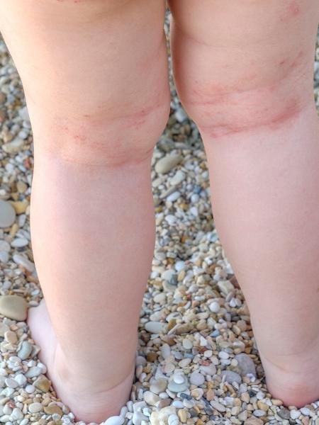Dermatite atópica é uma doença crônica que pode ser ocasionada por ácaros - iStock