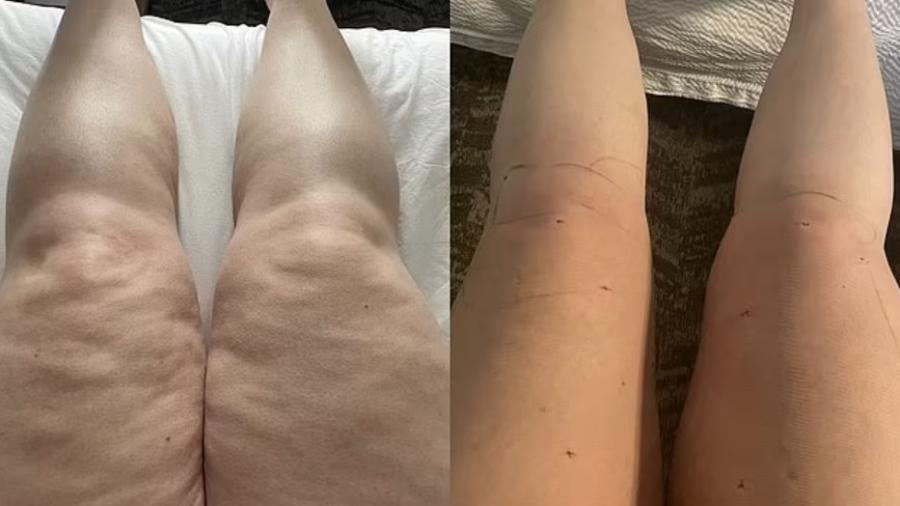Alisa Vandercruyssen escutava que tinha "problemas com peso", mas era lipedema; foto mostra antes e depois - Divulgação Alisa Vandercruyssen/SWNS