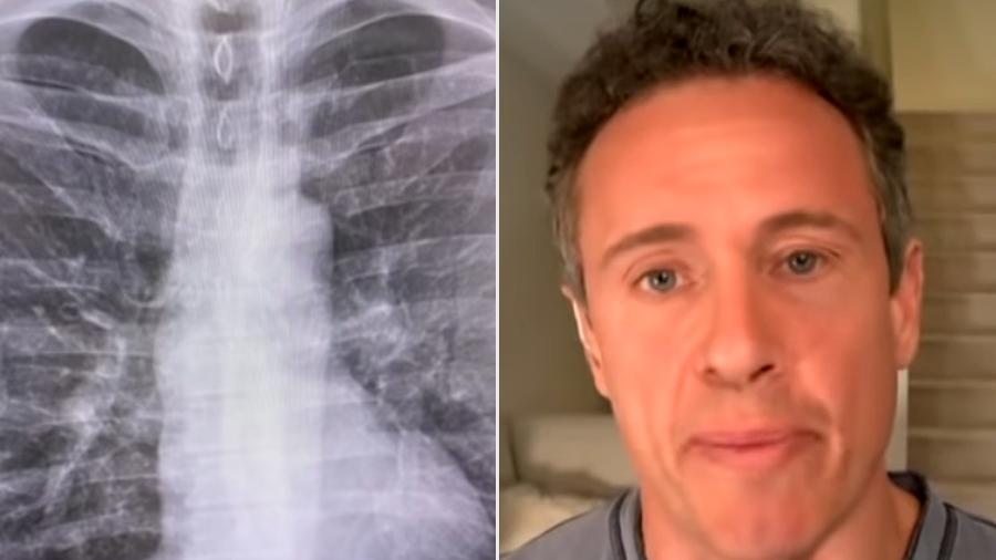 Chris Cuomo, âncora da CNN, e o raio-x que mostra a mancha nos pulmões - Reprodução