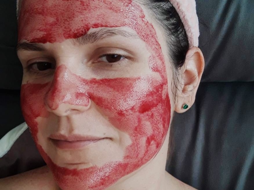 Peeling químico que promete pele de blogueira entrega vermelhidão e coceira
