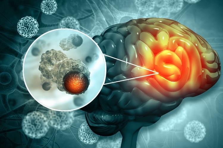 Os relatos dos pacientes com câncer acabavam tornando os estudos tendenciosos, acredita Ken Karipidis