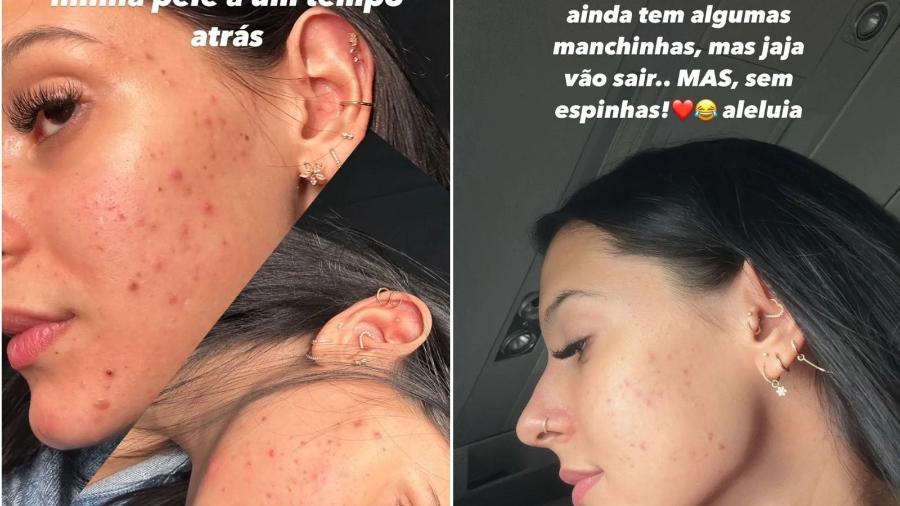 Ana Castela compartilha antes e depois de procedimento estético no rosto.