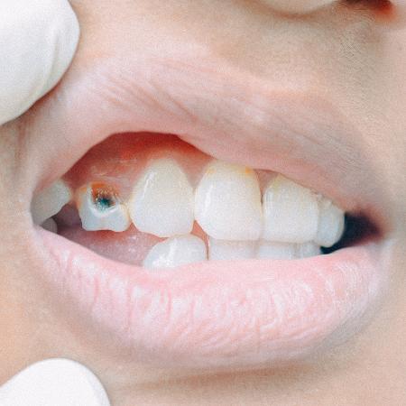 Estudo analisa medicamento que pode ajudar a estimular a regeneração do dente - iStock