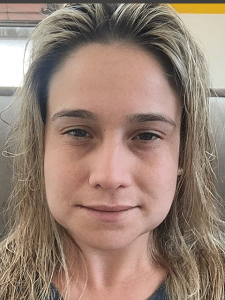 Fernanda Gentil com o rosto inchado - Reprodução/Instagram