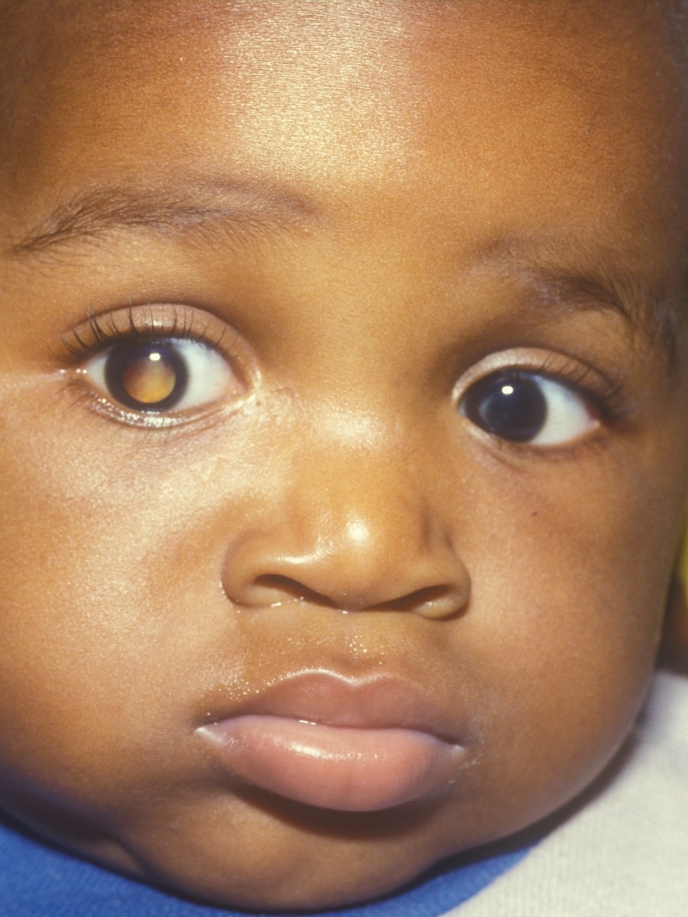 Retinoblastoma, um câncer raro que pode ocorrer nos olhos das crianças -  Blog Saúde Infantil