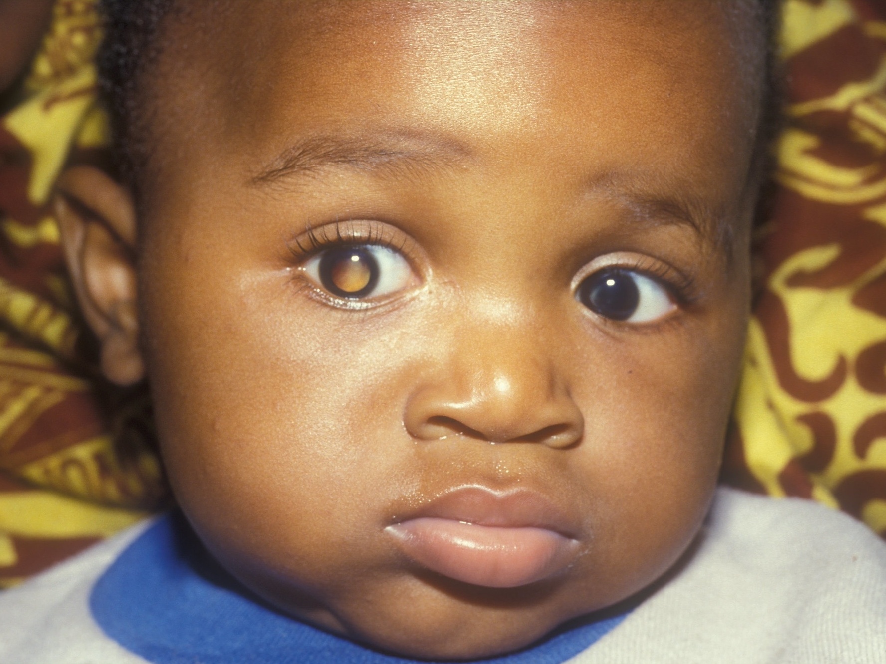 Tirar uma foto com flash pode detectar tumor ocular mais ...