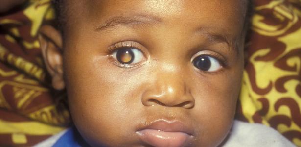 Tirar Uma Foto Com Flash Pode Detectar Tumor Ocular Mais Comum Na Infancia 18 09 2020 Uol Vivabem