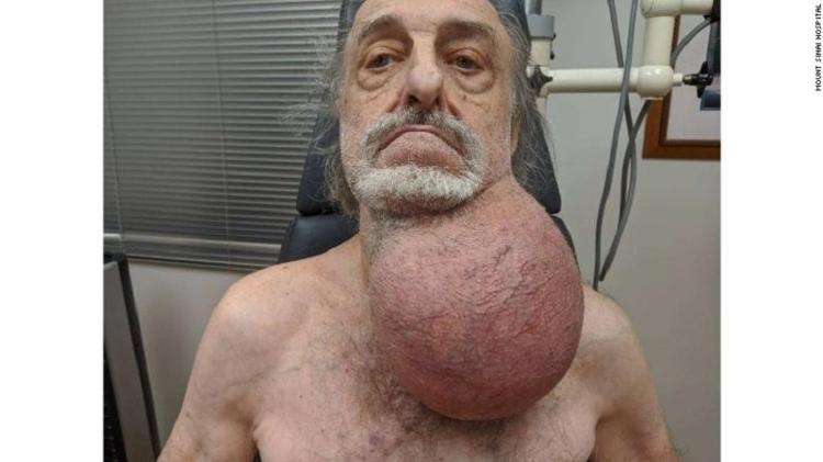 Milton Wingert, 81, teve que retirar o tumor que pesava 3 kg - Reprodução CNN/MOUNT SINAI HEALTH SYSTEM IN NYC