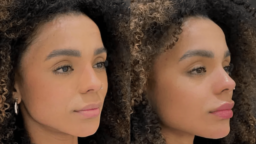 Brunna Gonçalves mostra antes e depois de harmonização facial - Reprodução/Instagram
