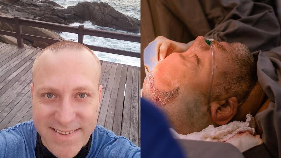 Sérgio Hondjakoff faz transplante capilar aos 37 anos  - Reprodução/Instagram
