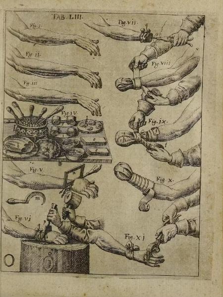 Um tratado do século 17 instrui os cirurgiões a usar um martelo e um cinzel, entre outros métodos de amputação