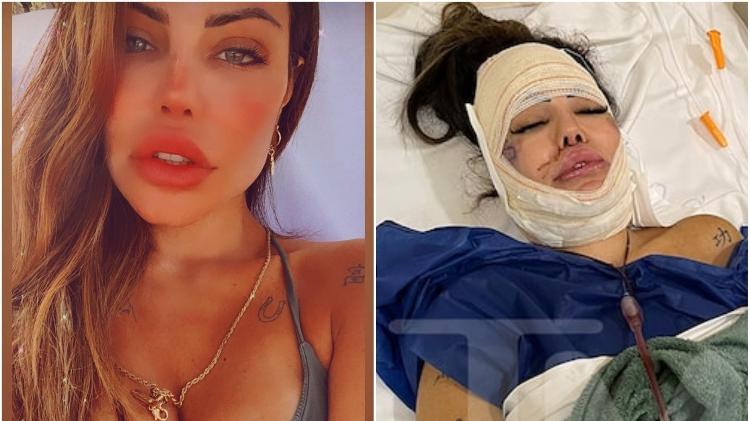 Liziane Gutierrez precisou passar por cirurgia para retirar produtos do rosto - Reprodução/Instagram/TMZ - Reprodução/Instagram/TMZ