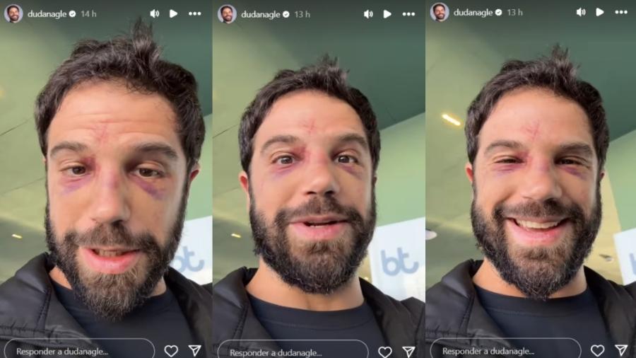 Duda Nagle mostrou rosto com hematomas e edemas após estreia como boxeador - Reprodução/Instagram