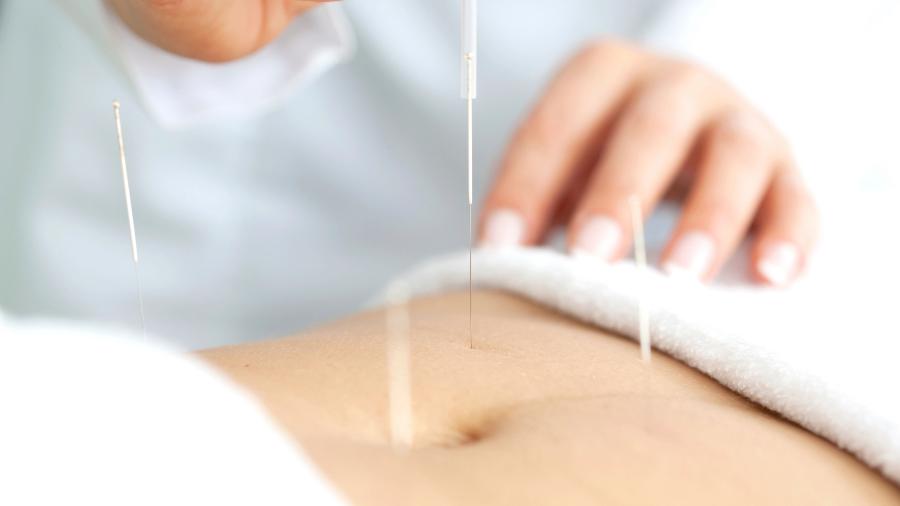Acupuntura tem se mostrado eficaz como técnica complementar nos tratamentos de fertilidade - Getty Images