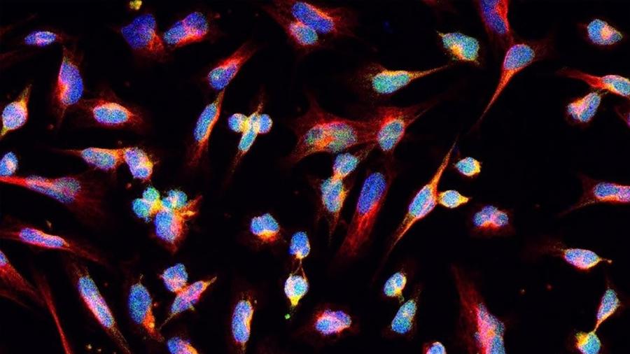 Nova ferramenta permite identificar e classificar diferentes tipos de tumores intracraneanos, como o glioma, que se inicia nas células da glia - Castro Lab, Michigan Medicine, Ann Arbor/NIH