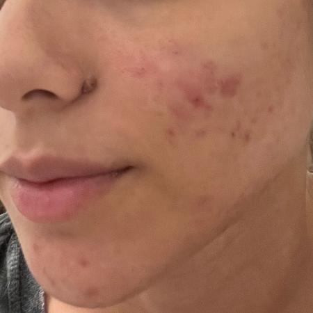 Antes de usar o produto, a acne era um problema