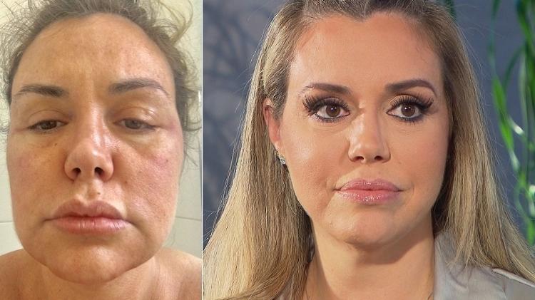 Renata Banhara, antes e depois da paralisia facial - Montagem/Divulgação/Record - Montagem/Divulgação/Record