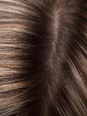 O Que O Couro Cabeludo E O Cabelo Podem Dizer Sobre A Sua Saude 10 06 2020 Uol Vivabem